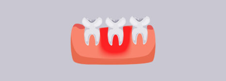 How to Treat Red Gums: When to See a Dentist for Professional Care